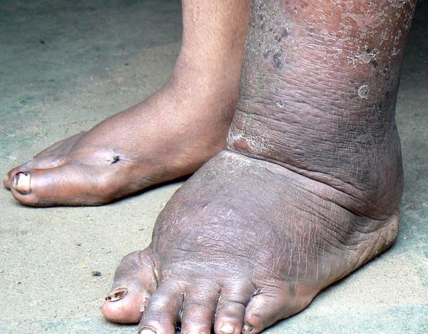 Sustained financing key to fighting NTDs in Ghana – GHS