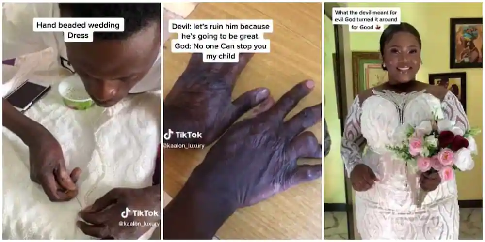 Talented designer with ‘burnt hands’ makes stunning wedding dress