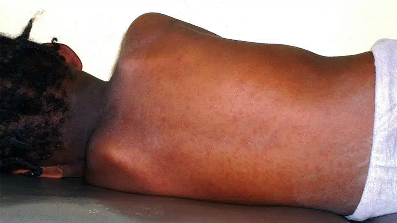 Vaccine shortage: Northern part of Ghana records over 100 measles cases