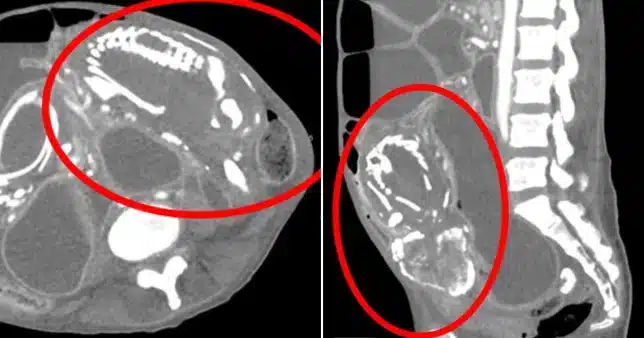 Woman died of malnutrition after carrying an unborn baby for nine years
