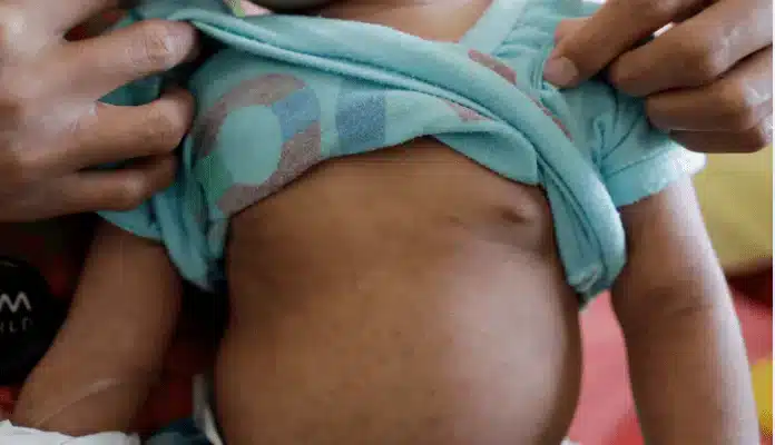 Close to 700k Ghanaian children at risk of Measles – WHO, CDC report