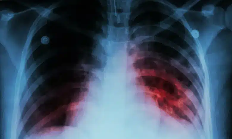 About 30 people die from tuberculosis every day – Health expert