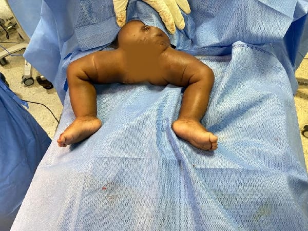 KATH surgeons successfully correct complex limb malformation on 5-month-old baby