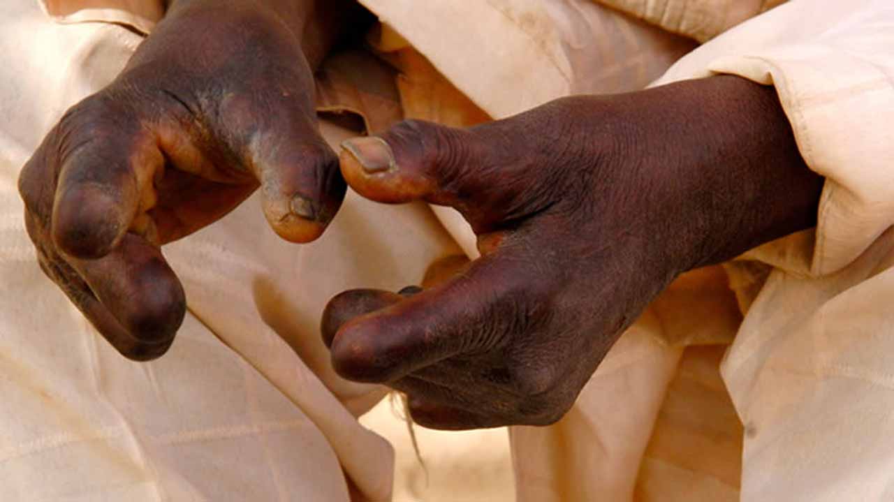 Leprosy, other diseases detected in Suhum Municipality