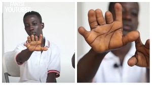 Find out more about the Ghanaian with 12 fingers and no nails
