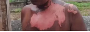 Woman sustains severe injuries after being drenched in boiling water laced with pepper