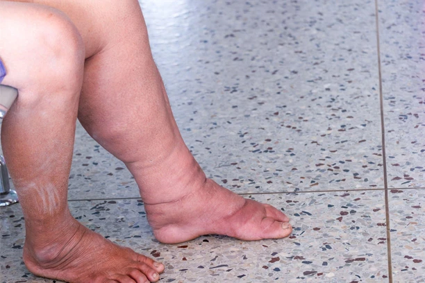 Elephantiasis cases soar in Upper East Region