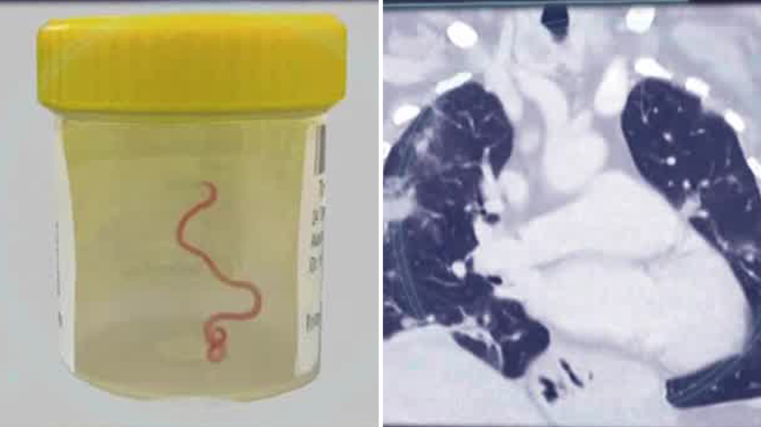 A live worm discovered within the brain of a woman in Australia