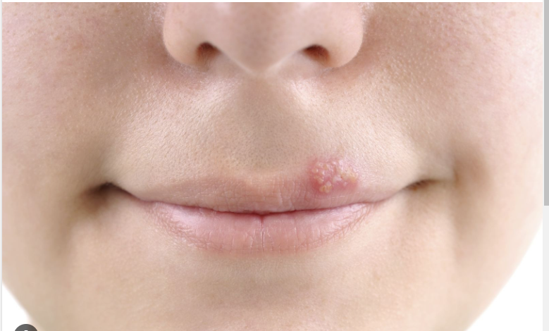 Causes of mouth sores and their solutions