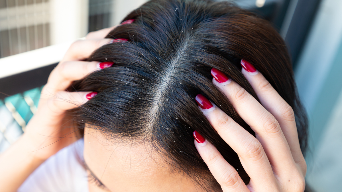 How to deal with dandruff the natural way