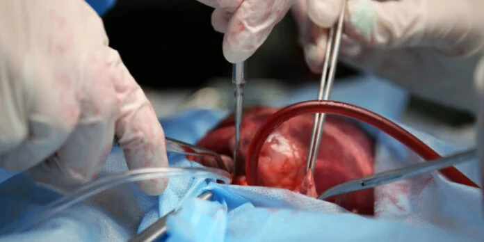 Transplantation services: Staff training ongoing to curb medical tourism – Korle-Bu