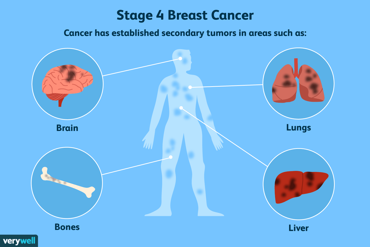 Breast cancer: Late detection can affect lungs, brain, and bones – GHS