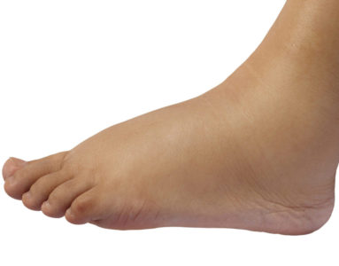 Important things to know about swollen feet