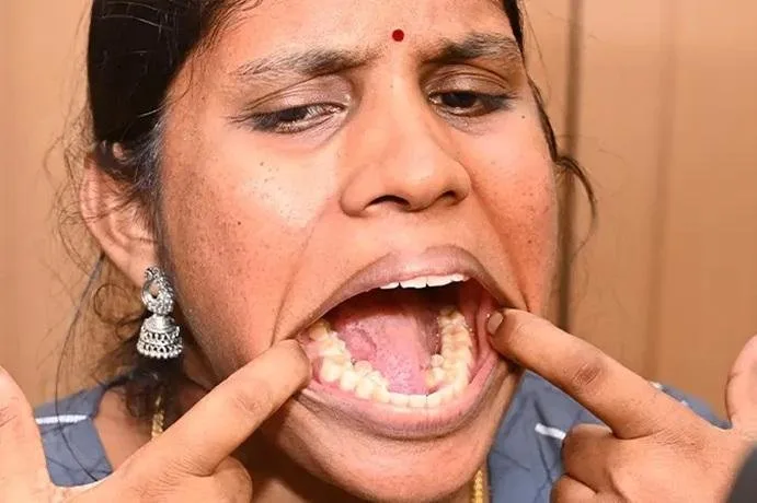 Kalpana Balan, the Indian woman with 38 teeth