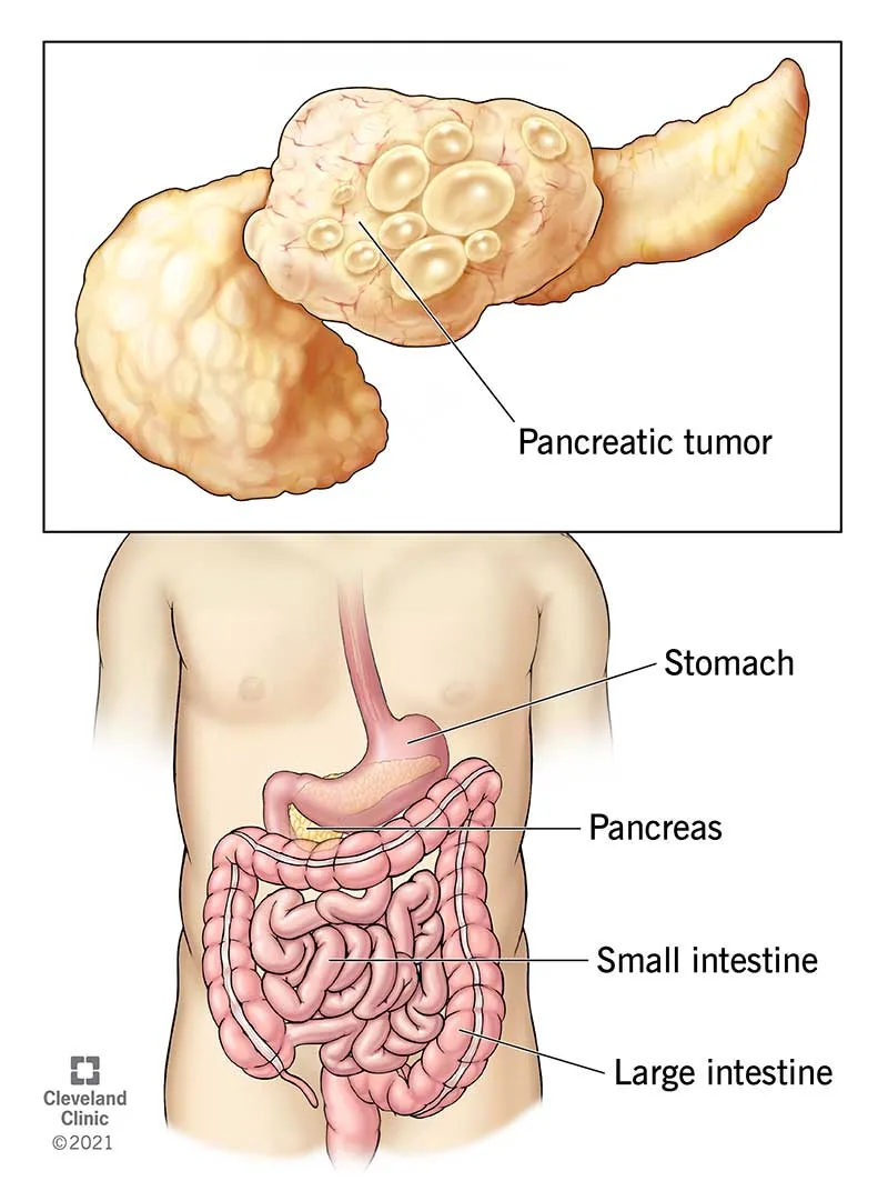 Symptoms and causes of pancreatic cancer you need to know