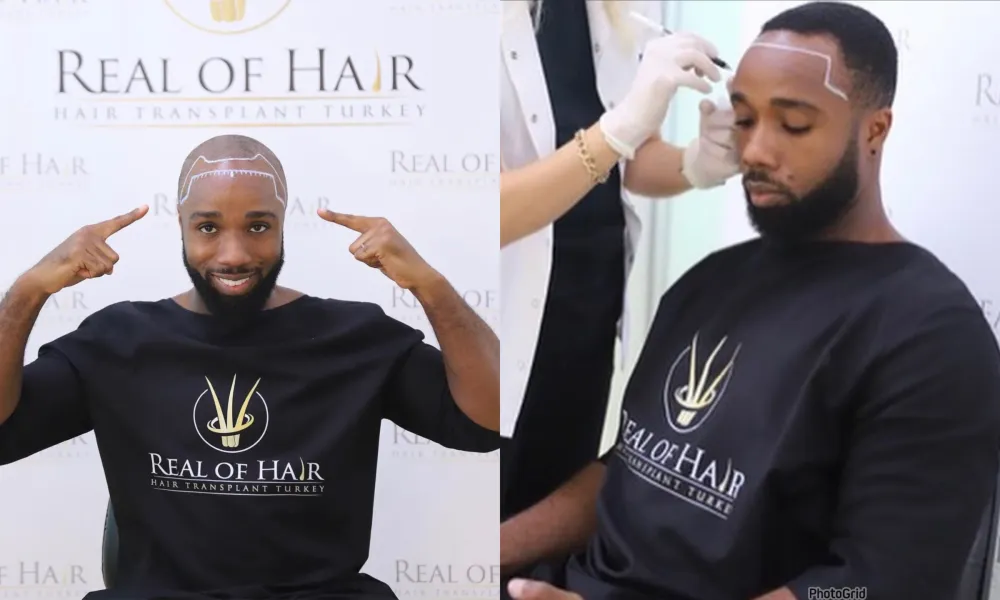 Fixing bald spots: Harold Amenyah shares story of hair transplant journey