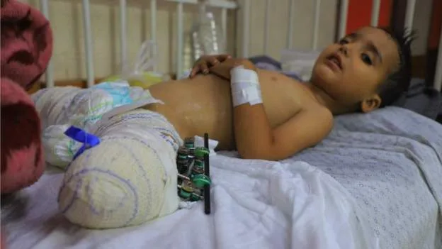 3-year-old Gazan child looses legs due to ongoing Israeli-Hamas war