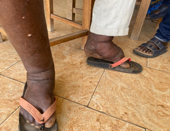 Sekyere East Health Directorate calls on public collaboration to fight neglected tropical diseases