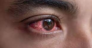 Understand the reasons for sudden red eyes in the morning and relief measures