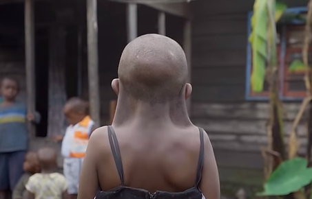 Stigma, pain plague 9-year-old girl with rare condition