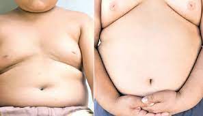 Global adult obesity set to exceed 1.53bn by 2035 – Report