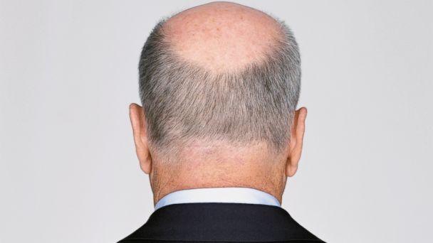 Is baldness caused by frequent wearing hats?