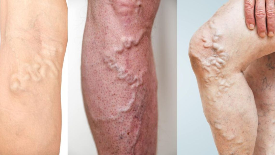 Deep vein thrombosis: A silent killer