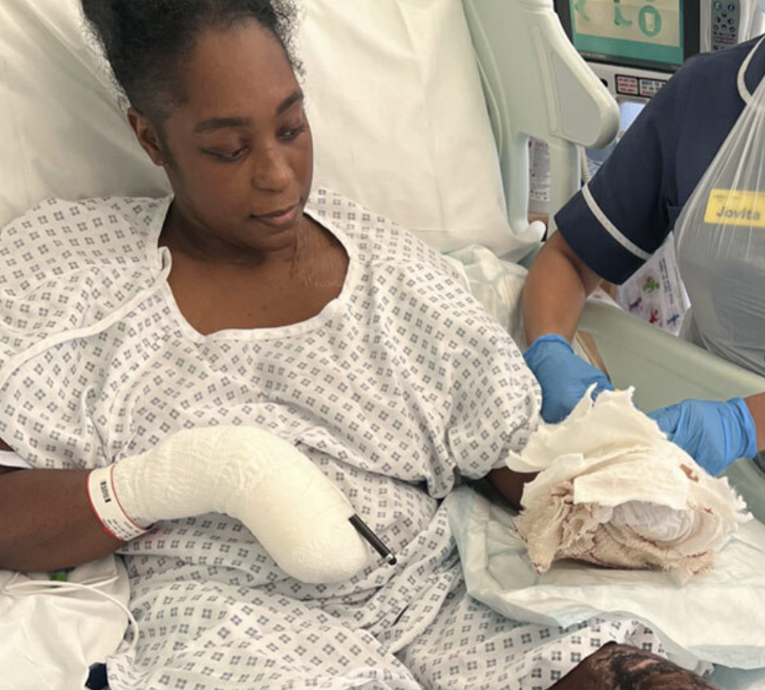 London: Woman develops post-partum sepsis after giving birth to twins, nearly loses all of her limbs