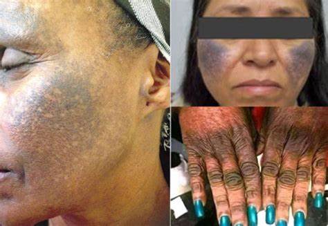 Bleaching, body enhancement; the evolving cause of high blood pressure