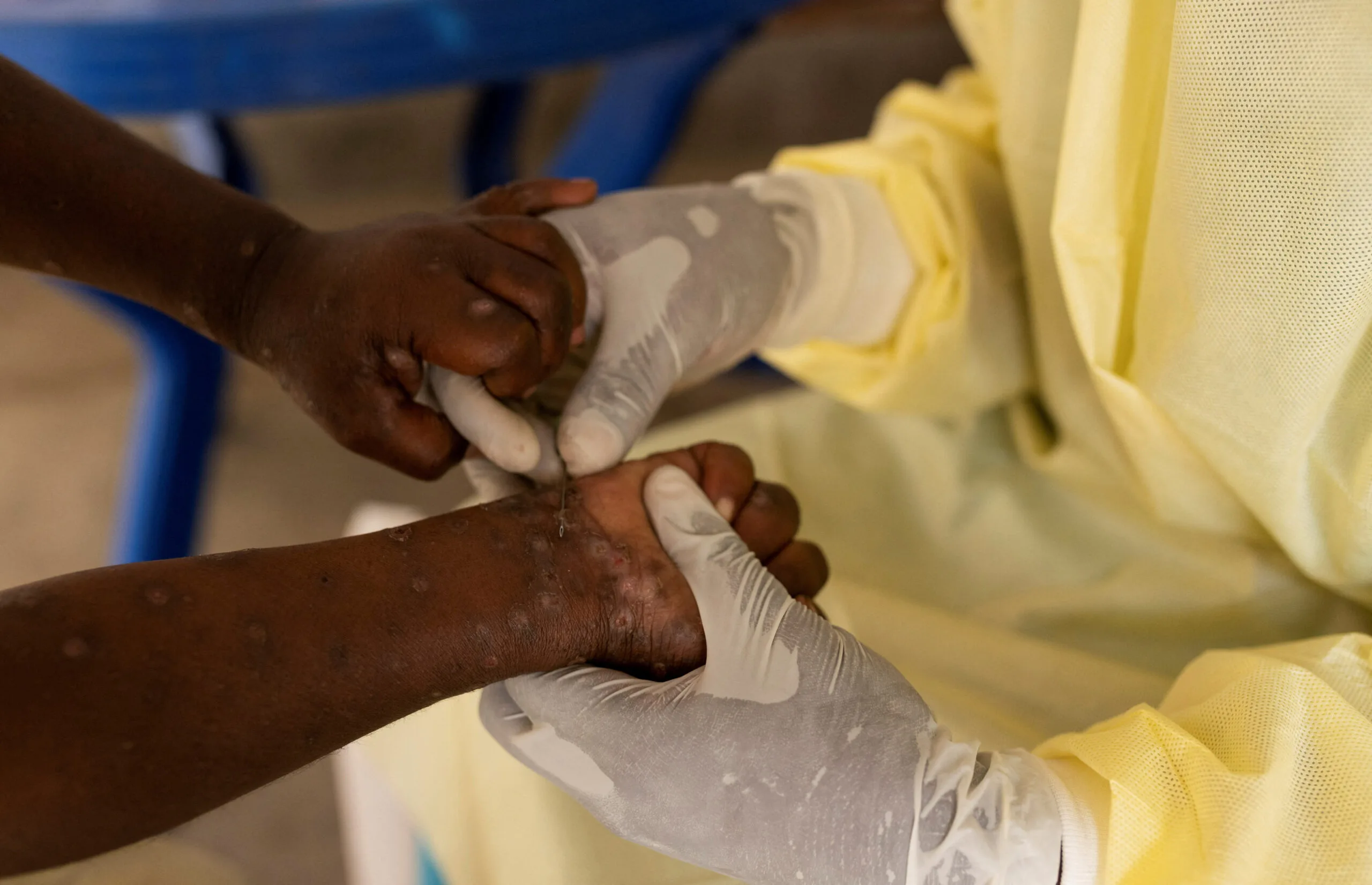 Mpox: Ghana Health Service announces 11 new cases, urges public to stay alert