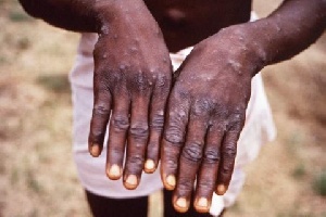 Mpox detected in Nkwanta North for the first time