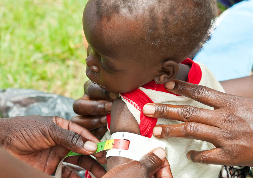 Malnutrition claims two children’s lives in Bawku