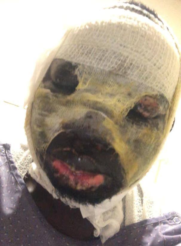 Woman arrested for attacking ex with acid in Accra