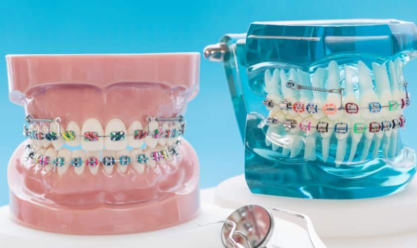 Dentist raises alarm over cosmetic braces trend, warns of permanent jaw damage