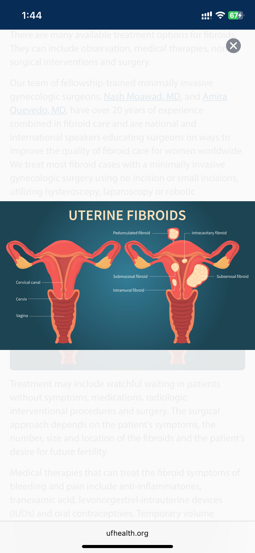 Untreated fibroids linked to kidney injuries, disease – Doctors warn in new study